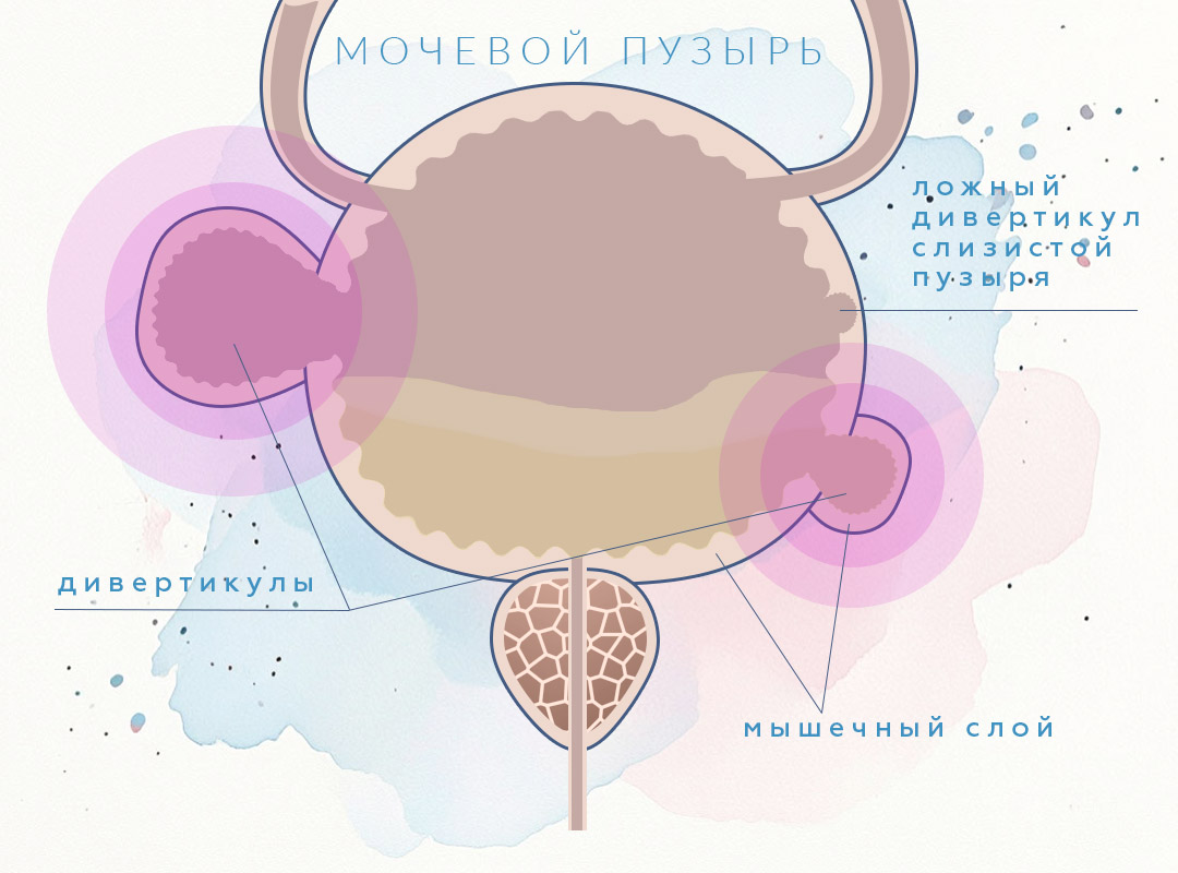 Симптомы и признаки дивертикулов мочевого пузыря