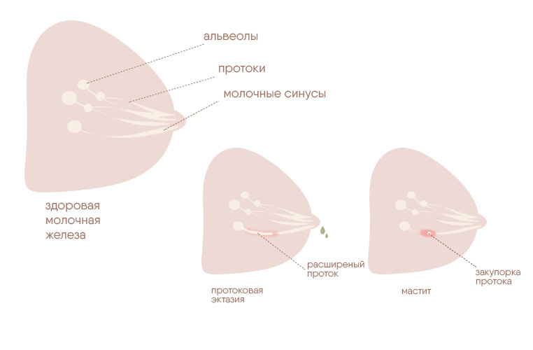 Протоки молочной железы: здоровые, протоковая эктазия, мастит — причины болей в груди после месячных