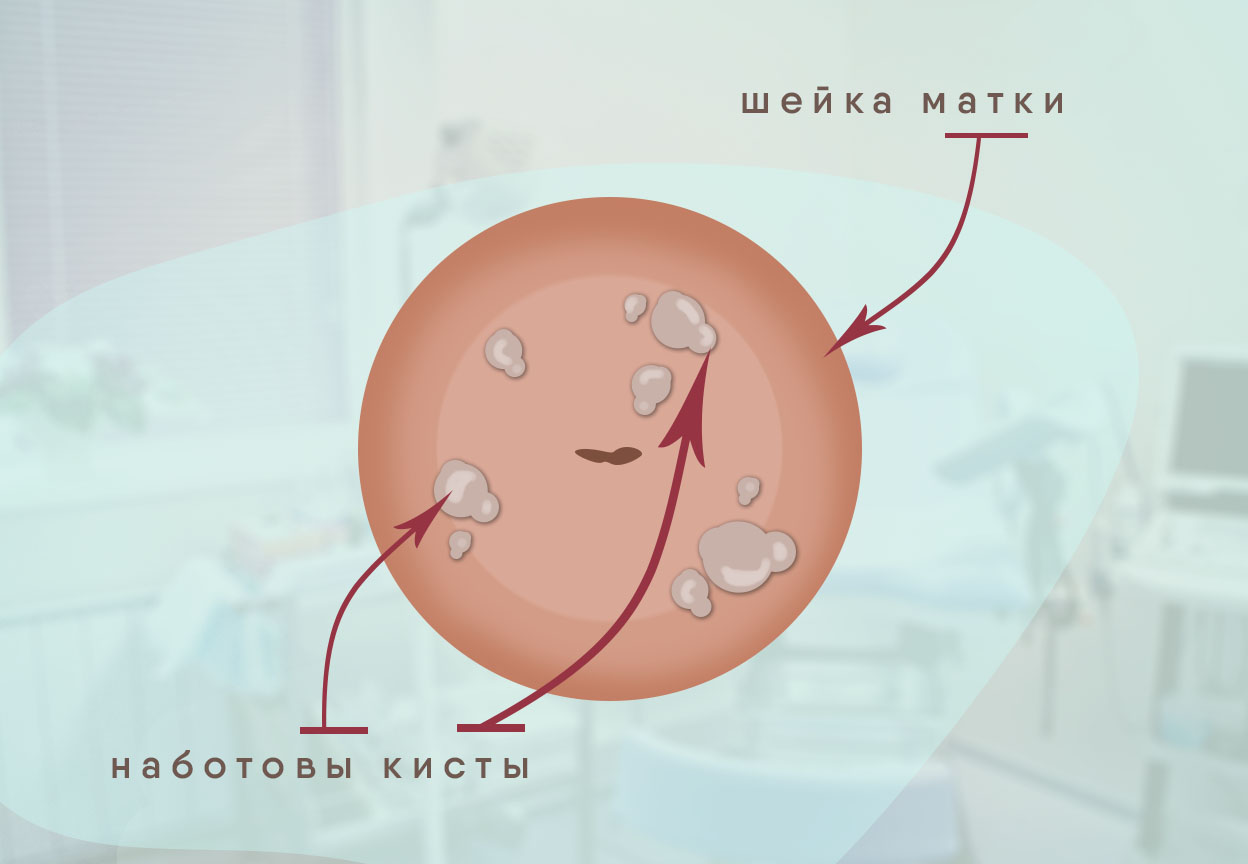 Лечение и контроль за развитием наботовых кист шейки матки у гинеколога в клинике ДеВита в Москве