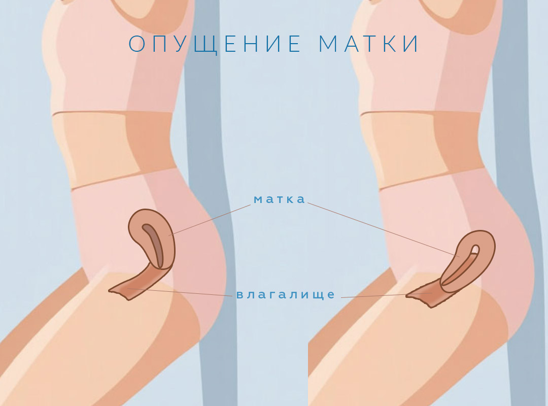 Симптомы и признаки опущения матки у женщин