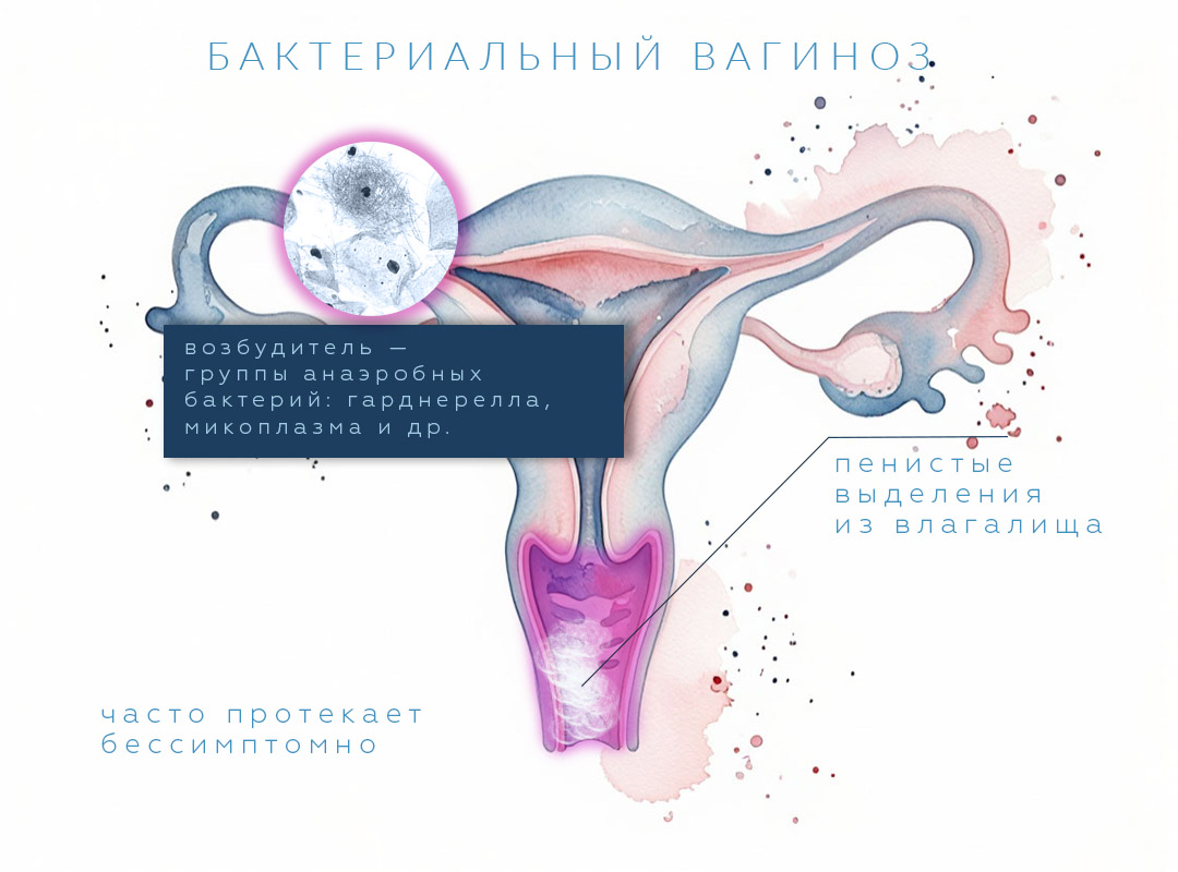 Симптомы бакториального вагиноза