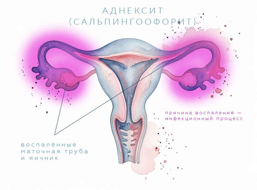 Причины и симптомы аднексита, сальпингоофорита у женщин