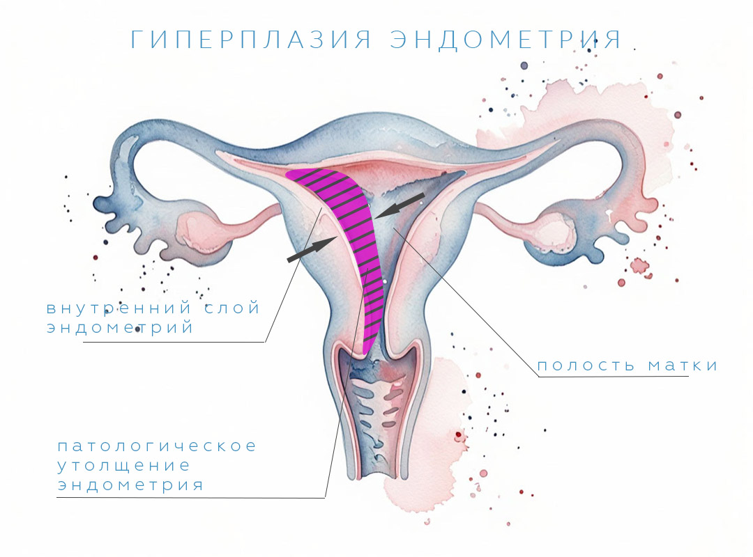 Лечение гиперплазии эндометрия в клинике ДеВита в Москве