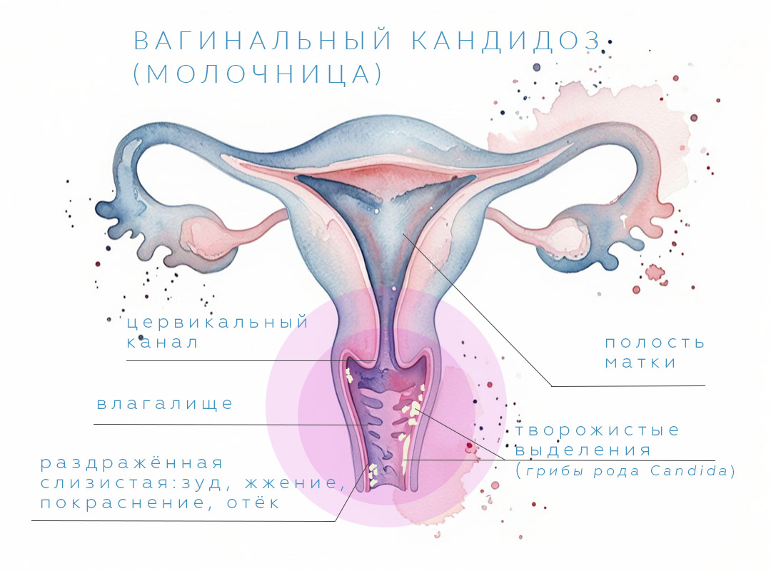 Основные признаки вагинальной молочницы у женщиин