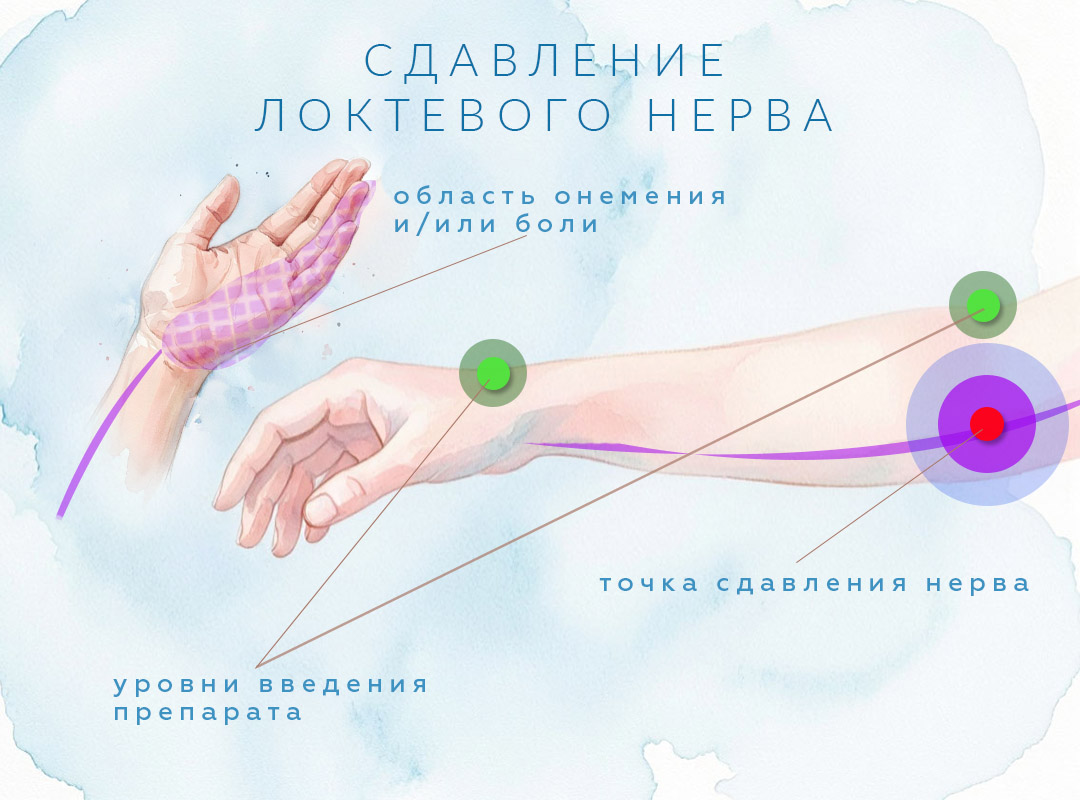 Симптомы защемления локтевого нерва, точки ввода блокады